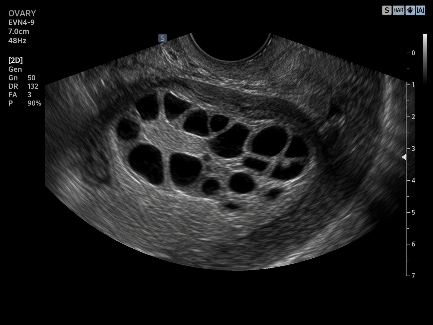 Ovarian ultrasound reference image — clinical context for ovarian reserve testing